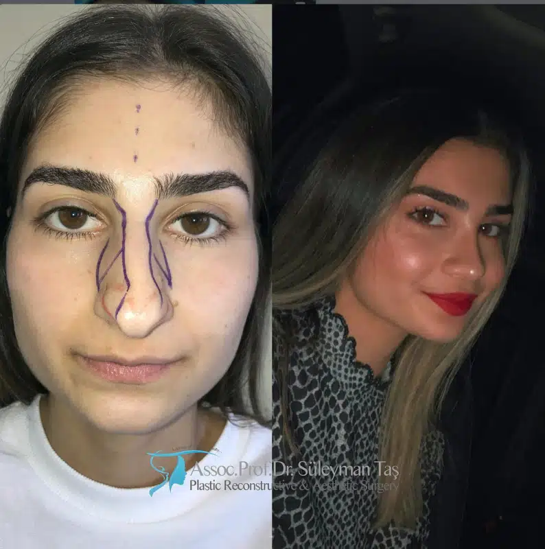 Suleyman Tas reviews – verified rhinoplasty patient review #186 (photo 3)