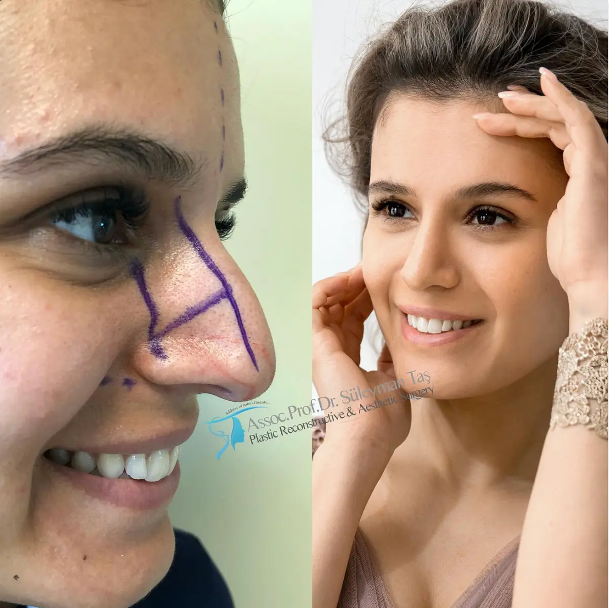Suleyman Tas reviews – verified rhinoplasty patient review #140 (photo 1)