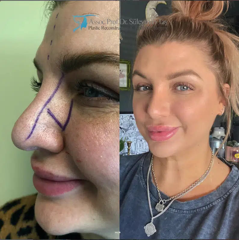 Suleyman Tas reviews – verified rhinoplasty patient review #178 (photo 3)