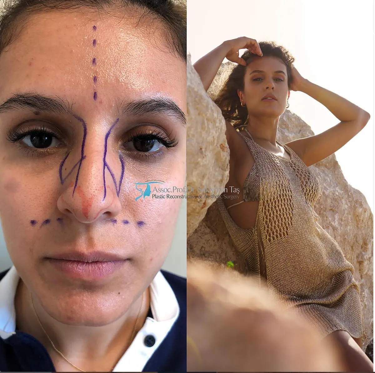 Suleyman Tas reviews – verified rhinoplasty patient review #118 (photo 2)