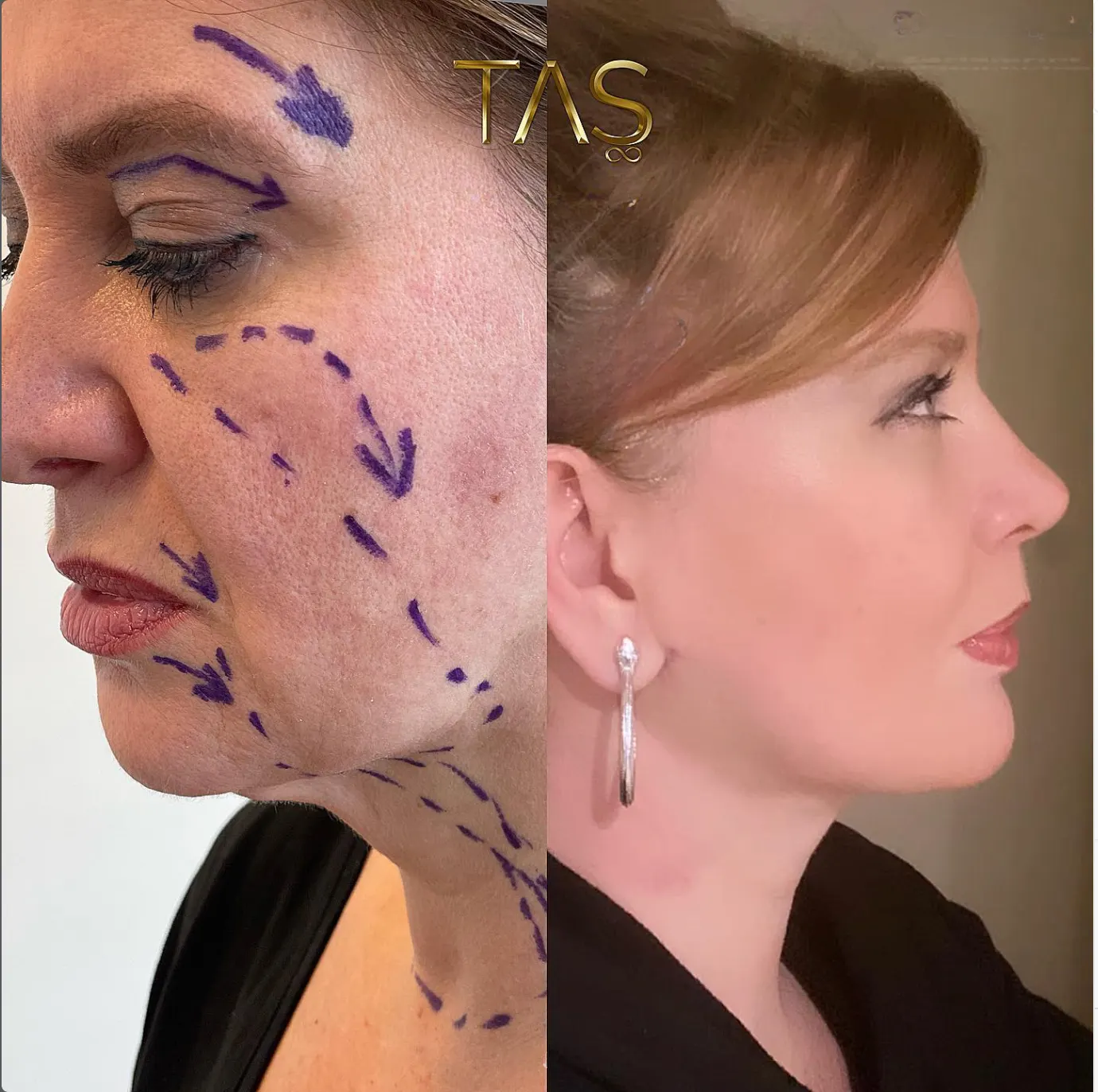 Suleyman Tas reviews – verified facelift patient review #53