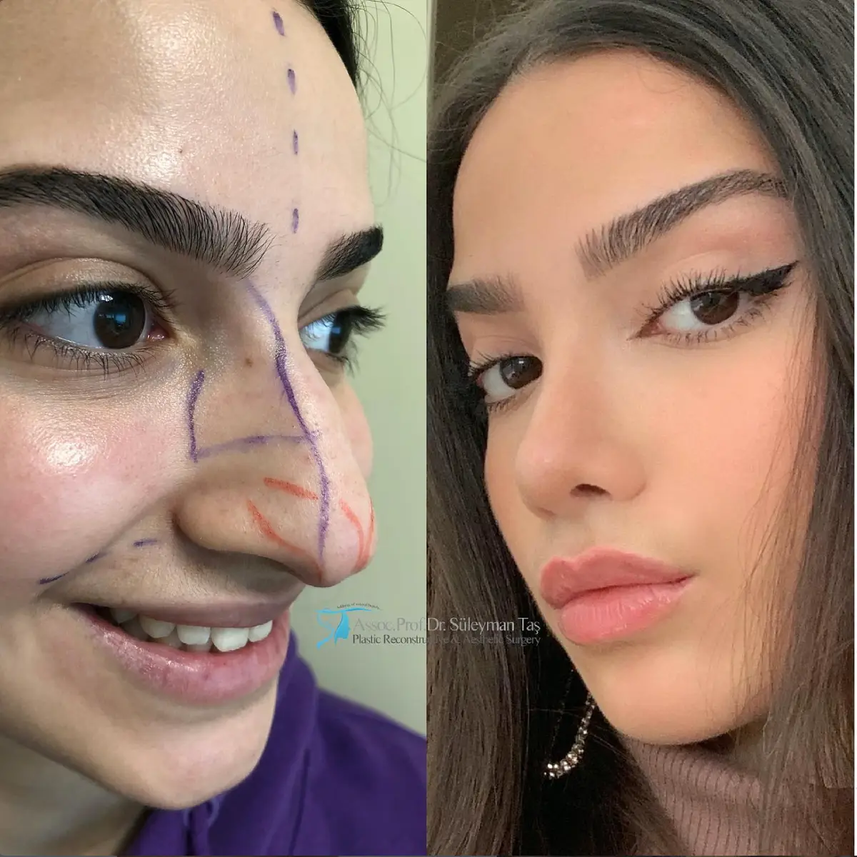 Suleyman Tas reviews – verified rhinoplasty patient review #130