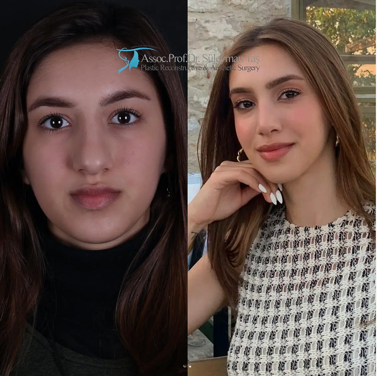 Suleyman Tas reviews – verified rhinoplasty patient review #167 (photo 1)
