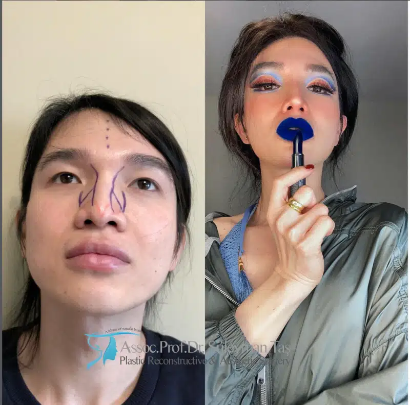 Suleyman Tas reviews – verified rhinoplasty patient review #185 (photo 2)