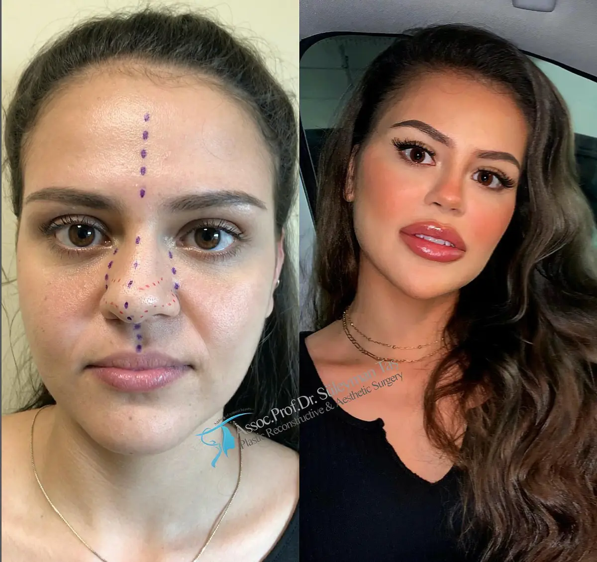 Suleyman Tas reviews – verified rhinoplasty patient review #157