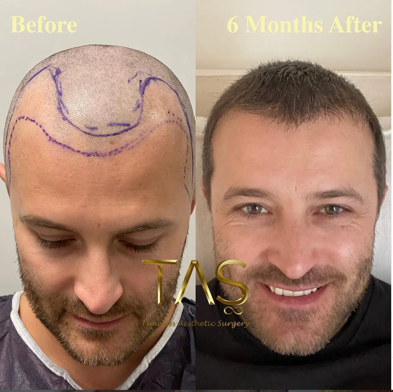 Suleyman Tas reviews – verified hair transplant patient review #46