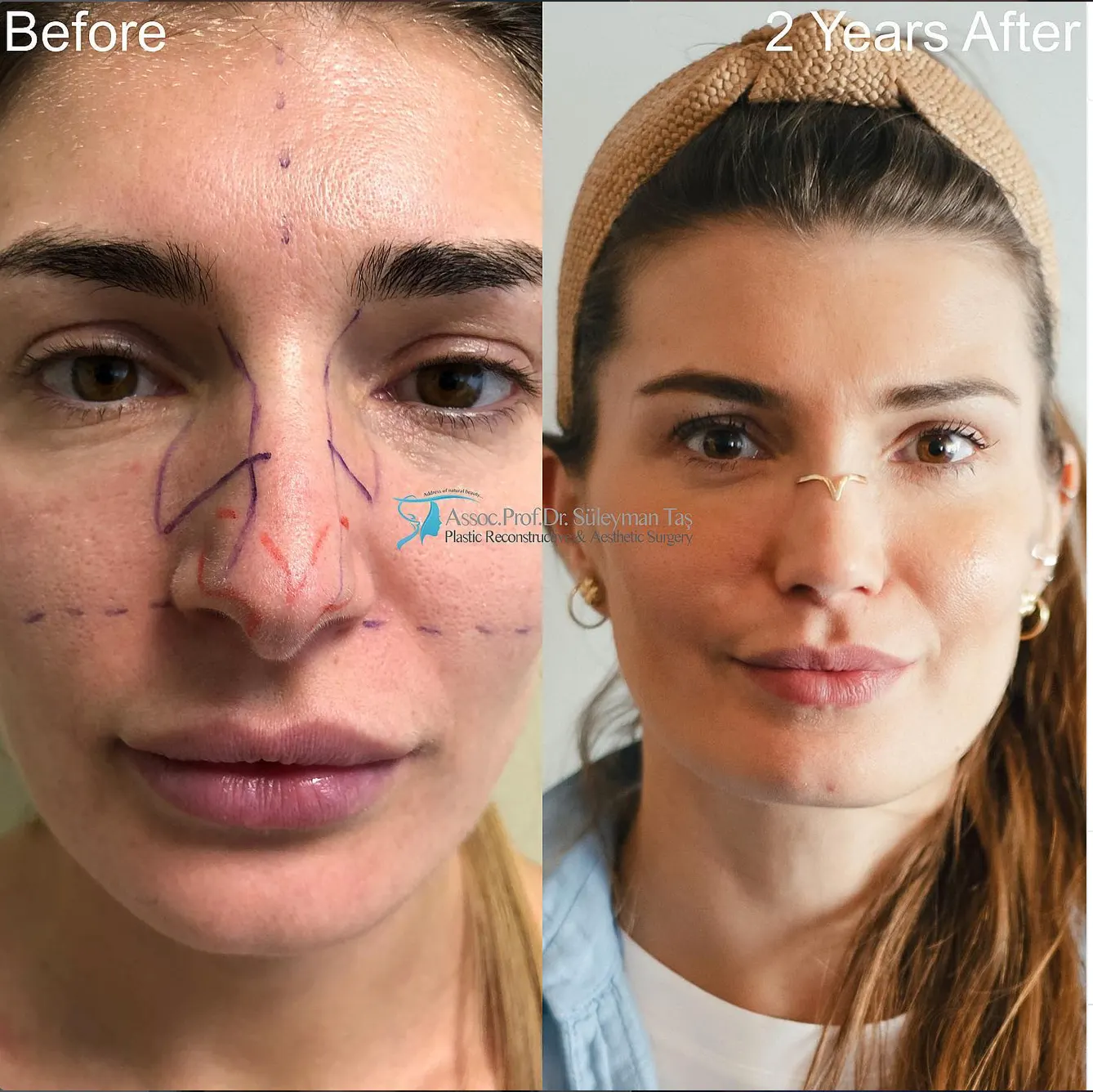 Suleyman Tas reviews – verified rhinoplasty patient review #76 (photo 4)