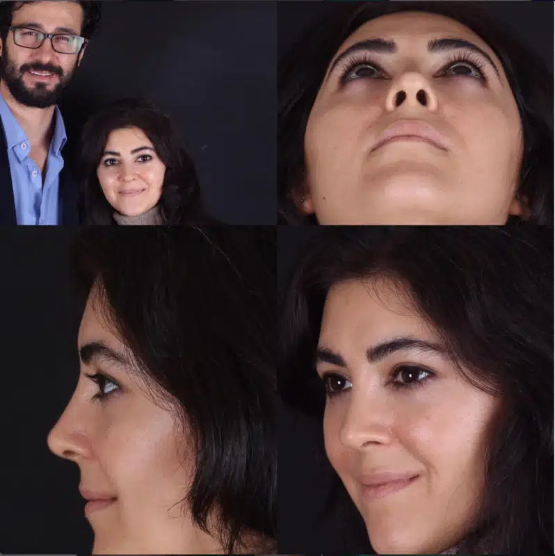 Suleyman Tas reviews – verified rhinoplasty patient review #248