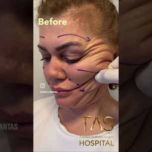 Facelift and neck lift, early recovery, patient of Prof. Dr. Suleyman Tas Clinic, Istanbul