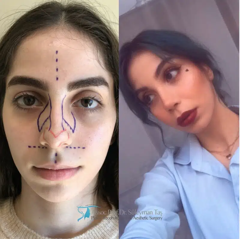 Suleyman Tas reviews – verified rhinoplasty patient review #181 (photo 2)