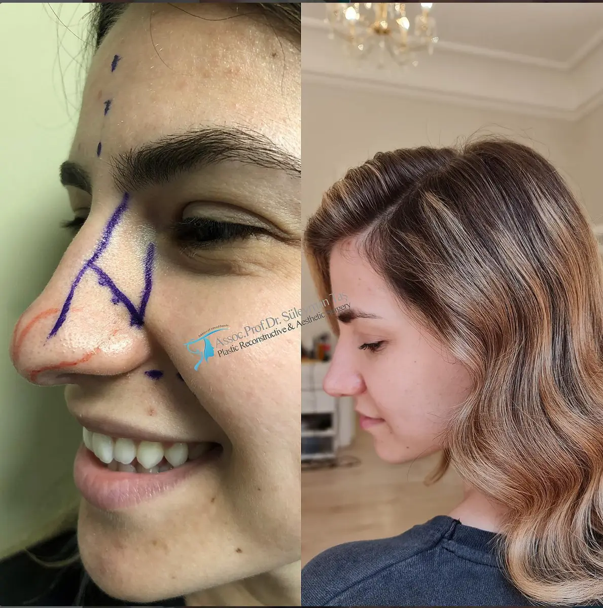 Suleyman Tas reviews – verified rhinoplasty patient review #116 (photo 2)