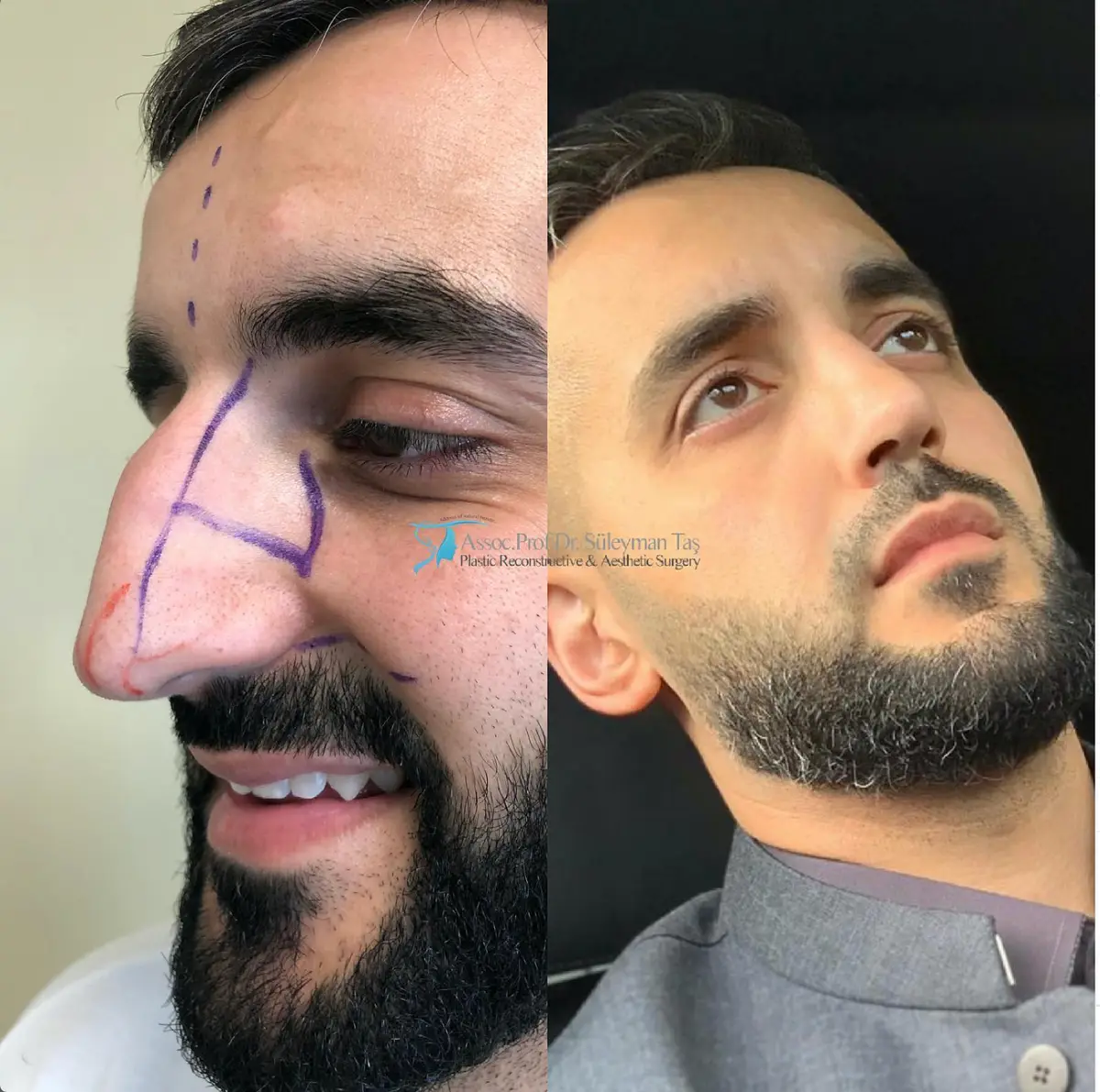 Suleyman Tas reviews – verified rhinoplasty patient review #131