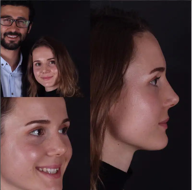 Suleyman Tas reviews – verified rhinoplasty patient review #252