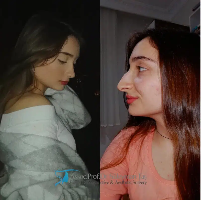 Suleyman Tas reviews – verified rhinoplasty patient review #179 (photo 1)