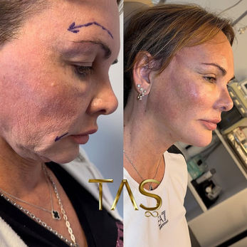 Facelift before and after photo of a female patient, side profile view, by Prof. Dr. Süleyman Taş, plastic surgeon in Istanbul