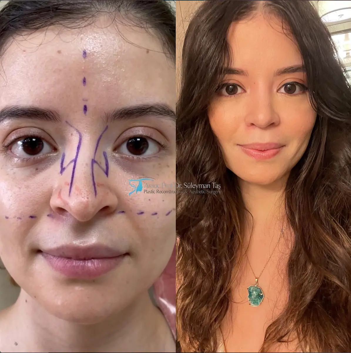 Suleyman Tas reviews – verified rhinoplasty patient review #114 (photo 1)