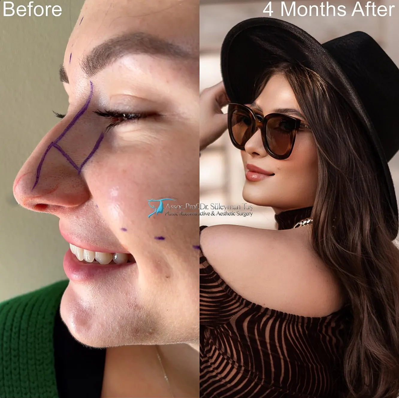 Suleyman Tas reviews – verified rhinoplasty patient review #81 (photo 3)