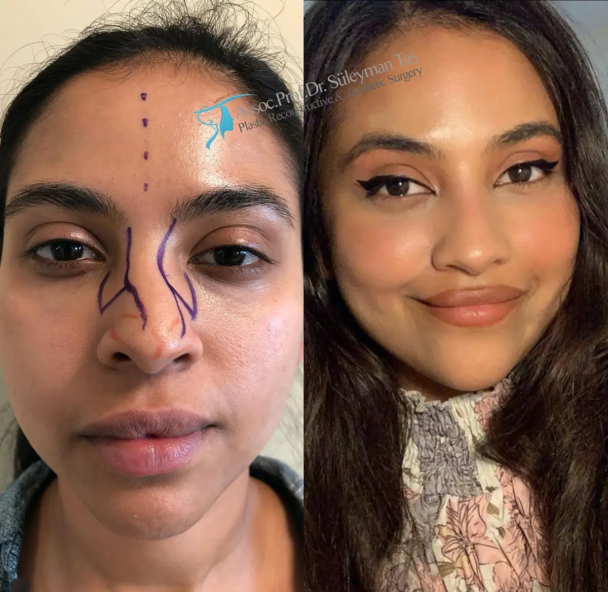 Suleyman Tas reviews – verified rhinoplasty patient review #159 (photo 1)