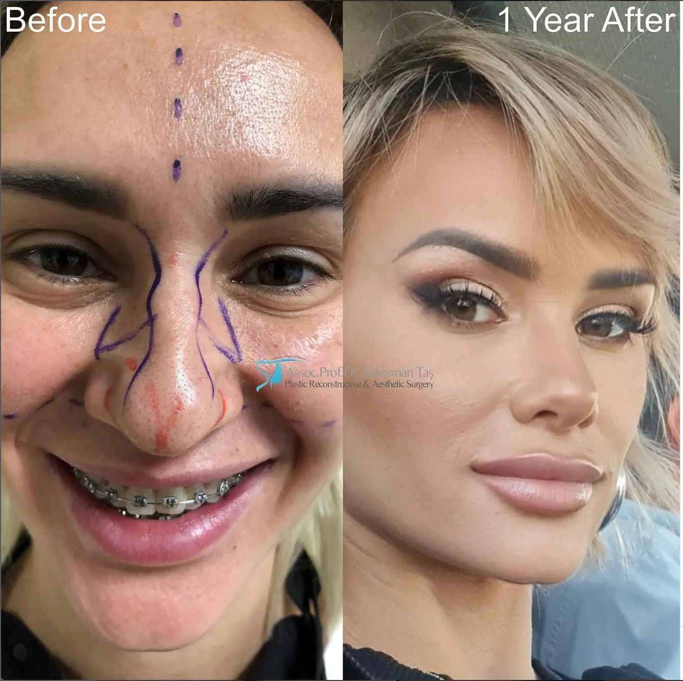 Suleyman Tas reviews – verified rhinoplasty patient review #84
