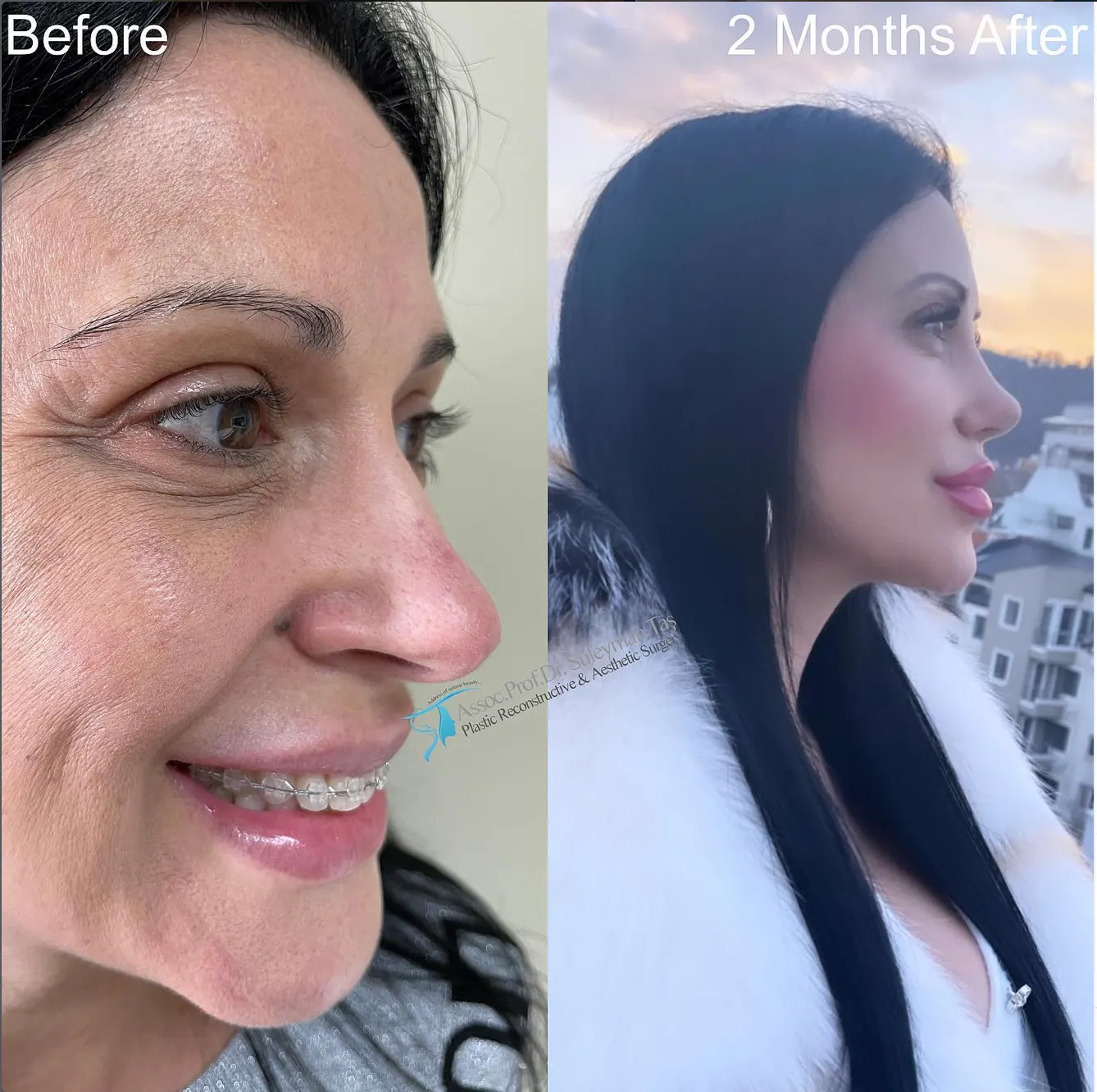Suleyman Tas reviews – verified facelift patient review #89 (photo 1)
