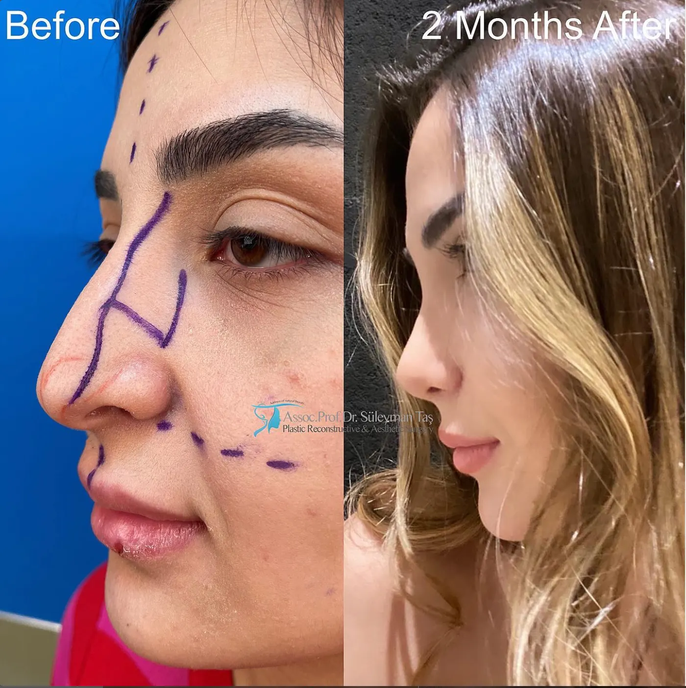 Suleyman Tas reviews – verified rhinoplasty patient review #63 (photo 1)