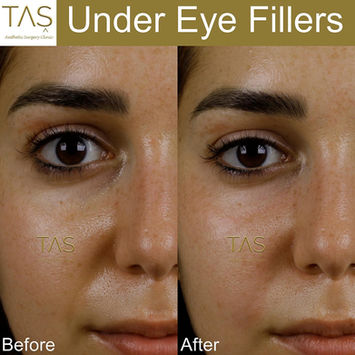 Under-Eye Filler before and after photo of a female patient, front view, immediately after surgery, by Prof. Dr. Süleyman Taş, plastic surgeon in Istanbul