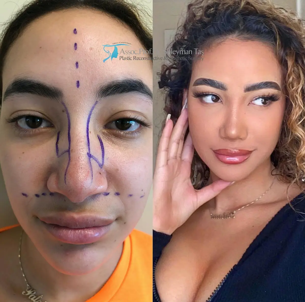 Suleyman Tas reviews – verified rhinoplasty patient review #160