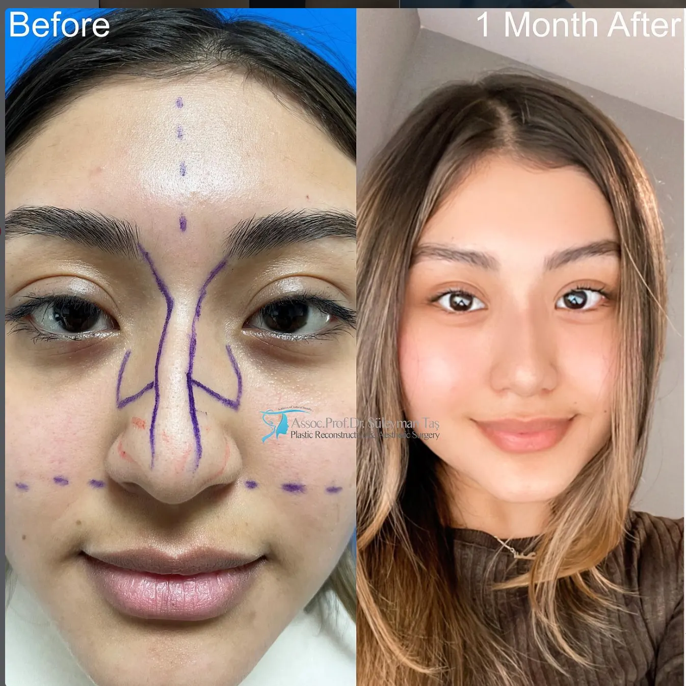 Suleyman Tas reviews – verified rhinoplasty patient review #77 (photo 1)