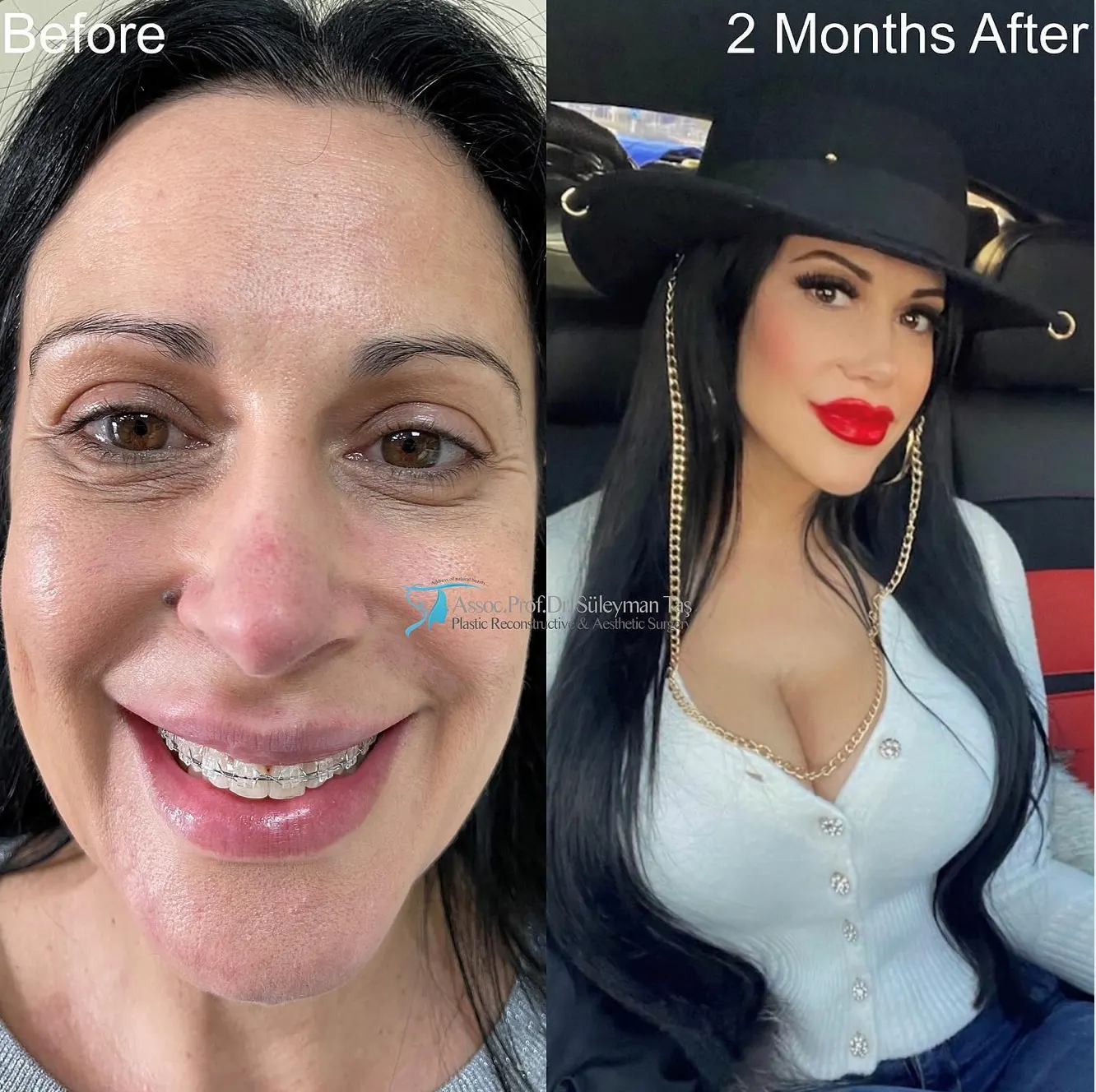Suleyman Tas reviews – verified facelift patient review #89 (photo 2)