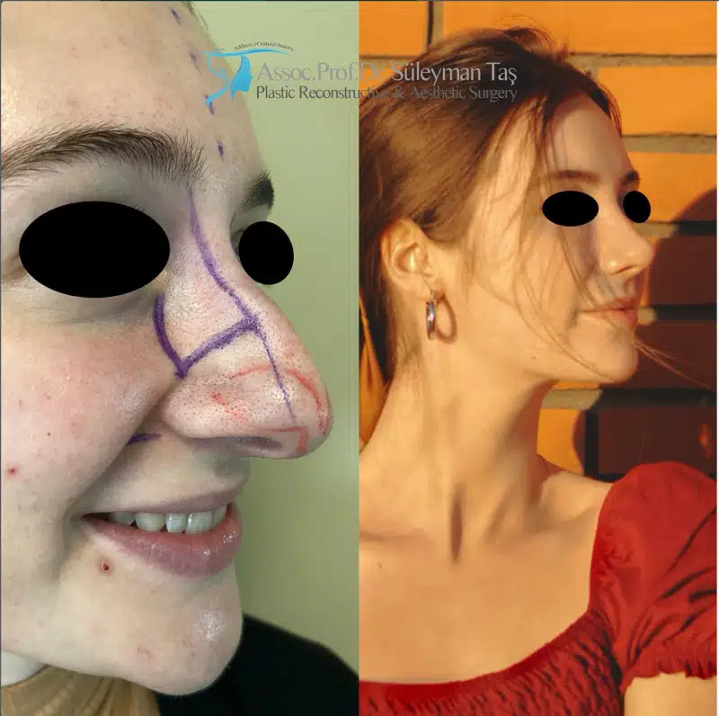 Suleyman Tas reviews – verified rhinoplasty patient review #171 (photo 2)