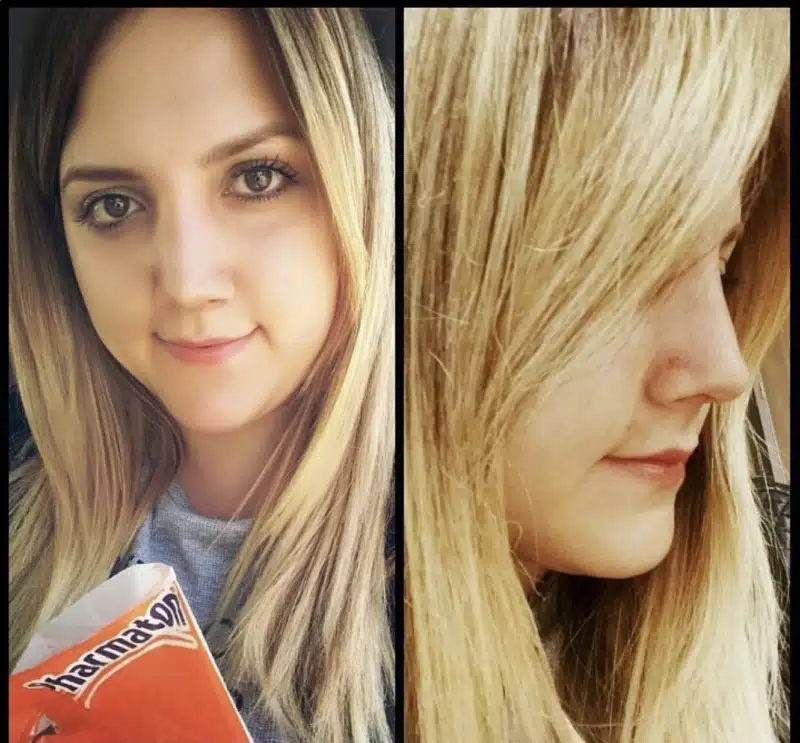 Suleyman Tas reviews – verified rhinoplasty patient review #322