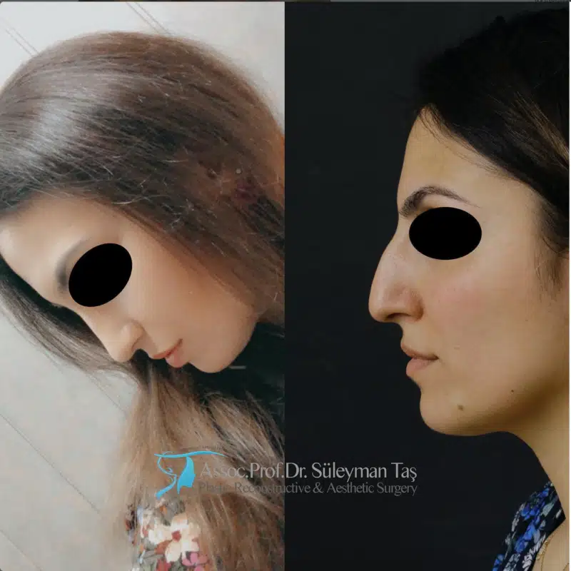 Suleyman Tas reviews – verified rhinoplasty patient review #187 (photo 2)
