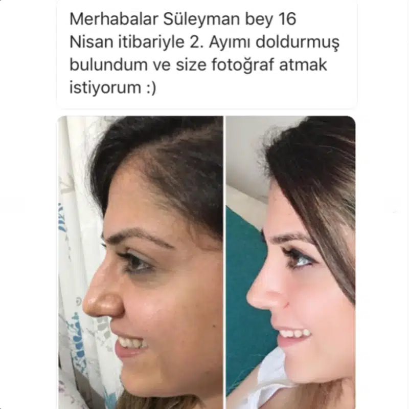Suleyman Tas reviews – verified rhinoplasty patient review #232 (photo 2)