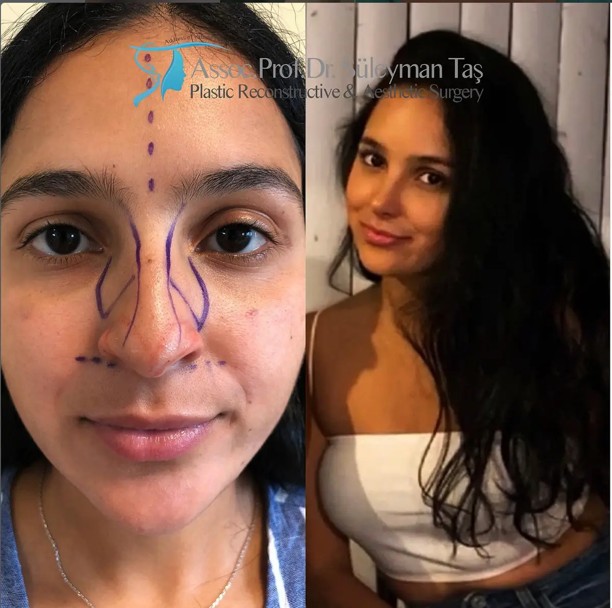 Suleyman Tas reviews – verified rhinoplasty patient review #164 (photo 3)