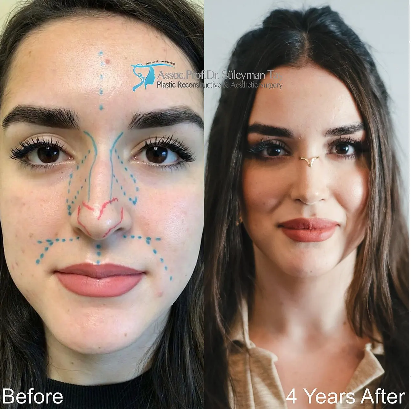 Suleyman Tas reviews – verified rhinoplasty patient review #73 (photo 1)