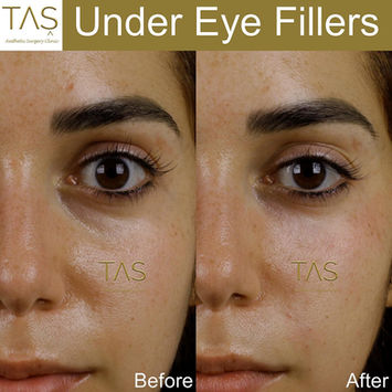 Under-Eye Filler before and after photo of a female patient, front view, immediately after surgery, by Prof. Dr. Süleyman Taş, plastic surgeon in Istanbul