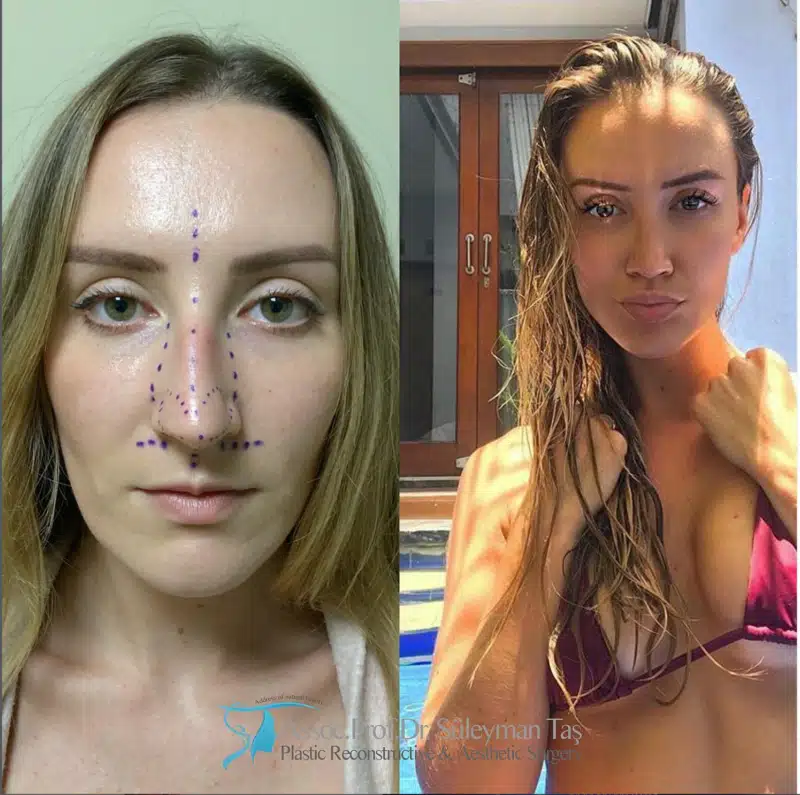Suleyman Tas reviews – verified rhinoplasty patient review #174 (photo 2)
