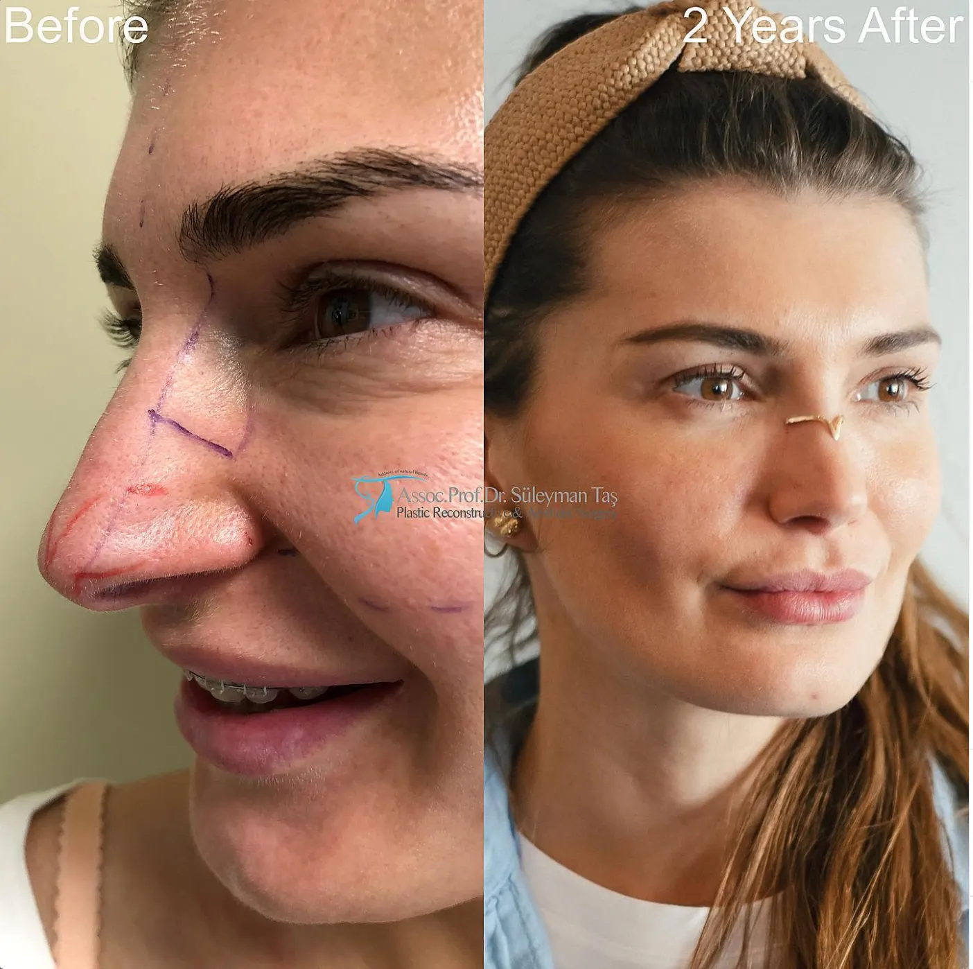 Suleyman Tas reviews – verified rhinoplasty patient review #76 (photo 2)