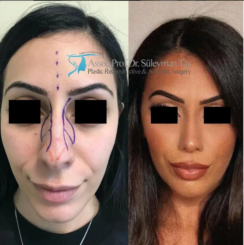 Suleyman Tas reviews – verified rhinoplasty patient review #190 (photo 1)