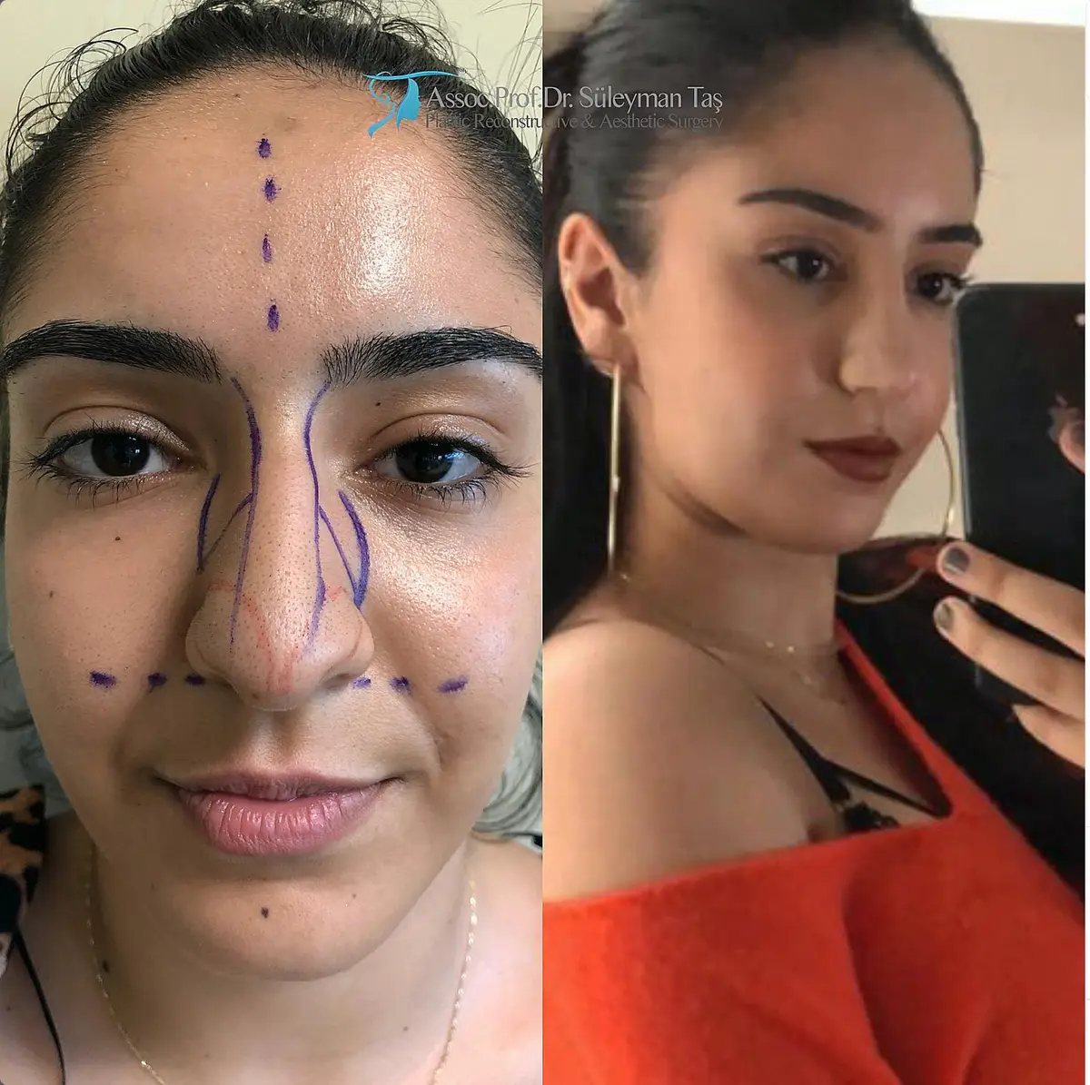 Suleyman Tas reviews – verified rhinoplasty patient review #161 (photo 1)