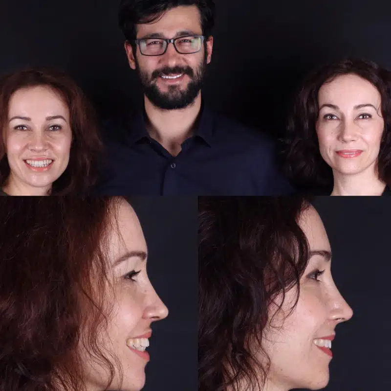 Suleyman Tas reviews – verified rhinoplasty patient review #270