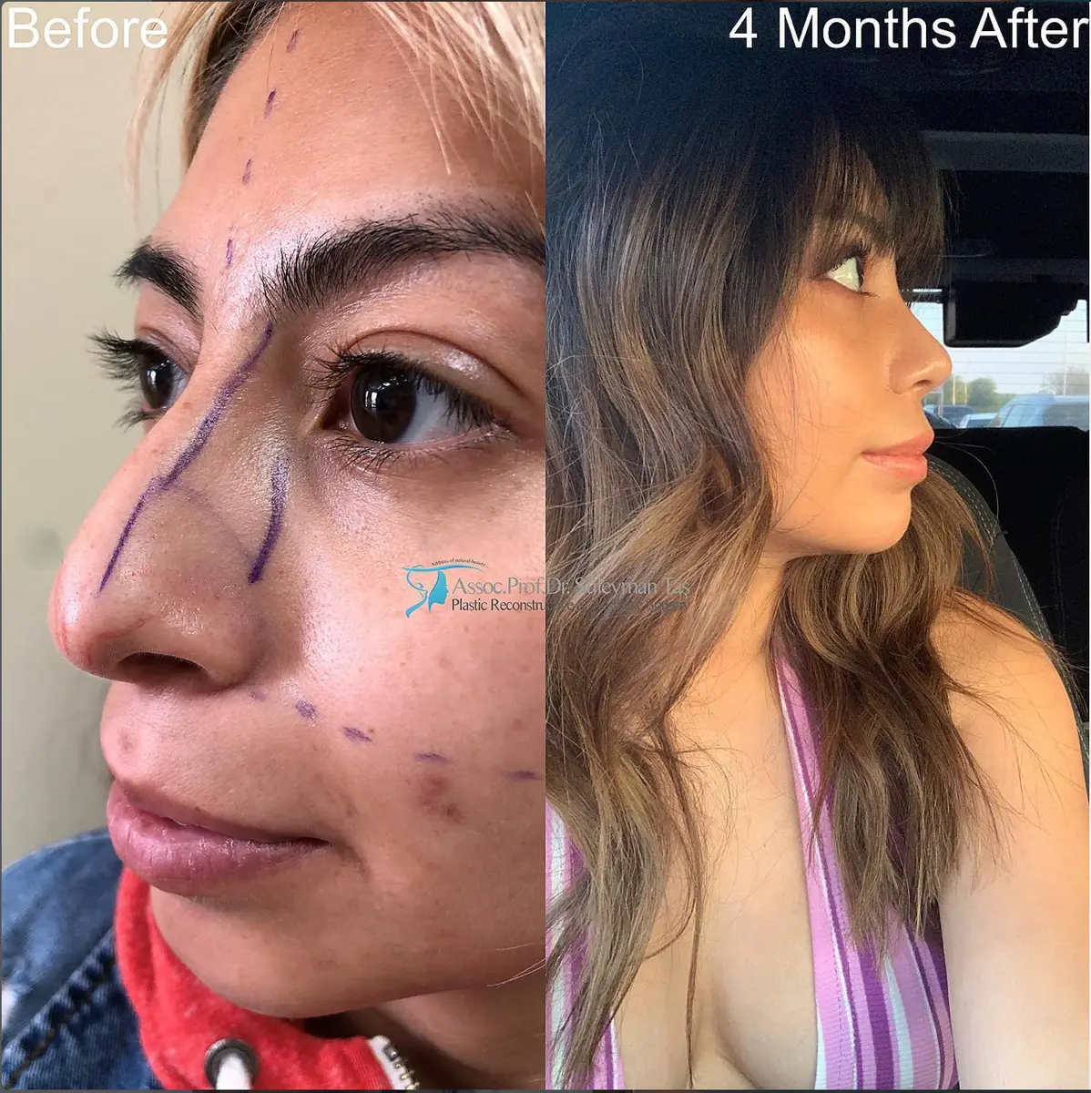 Suleyman Tas reviews – verified rhinoplasty patient review #107 (photo 1)