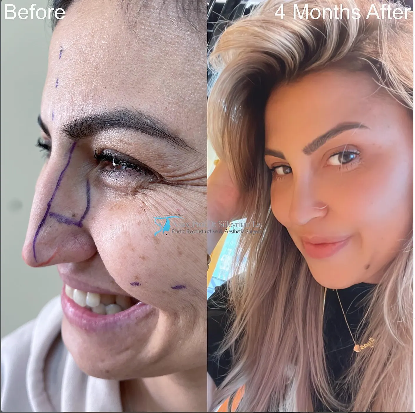 Suleyman Tas reviews – verified rhinoplasty patient review #65 (photo 1)