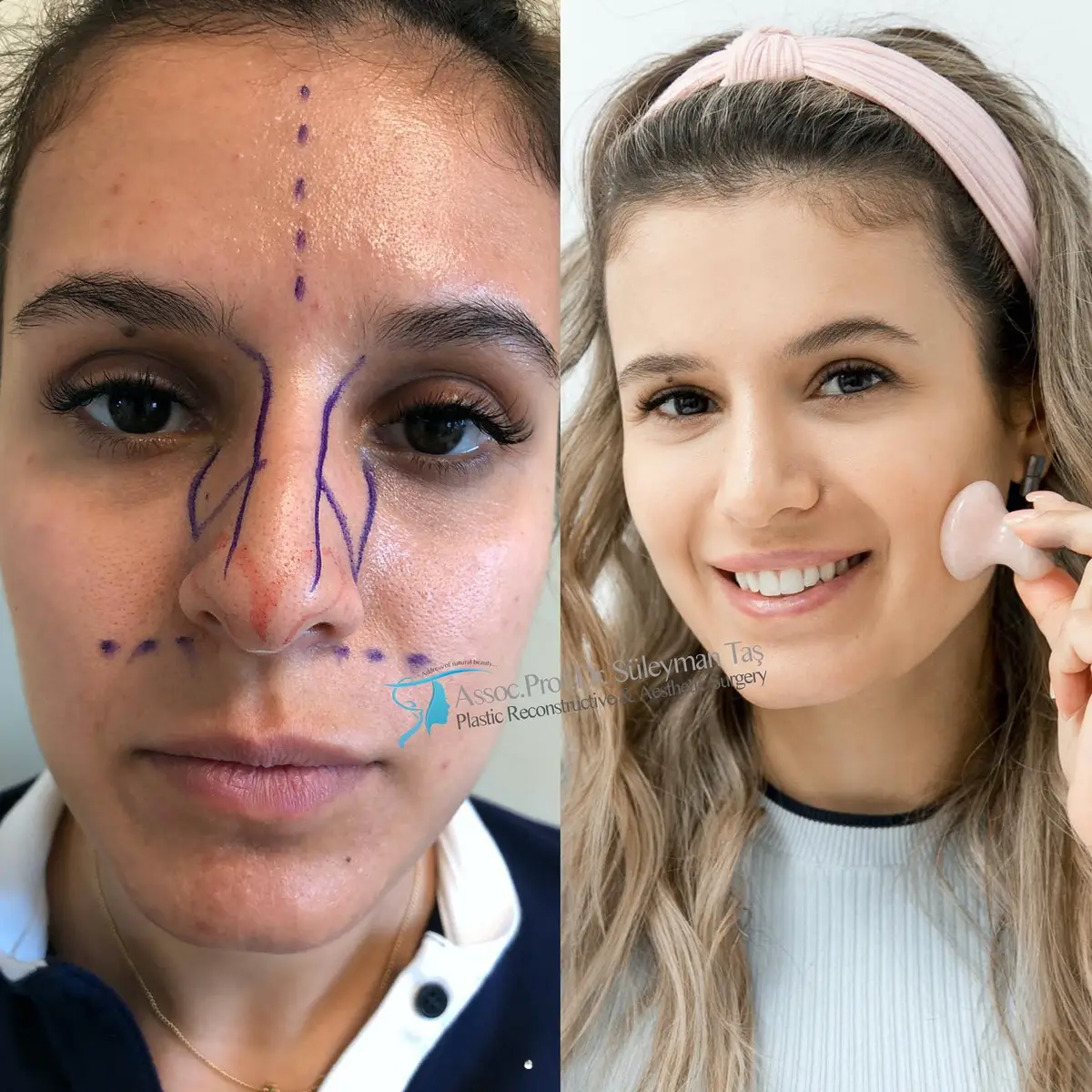 Suleyman Tas reviews – verified rhinoplasty patient review #140 (photo 2)