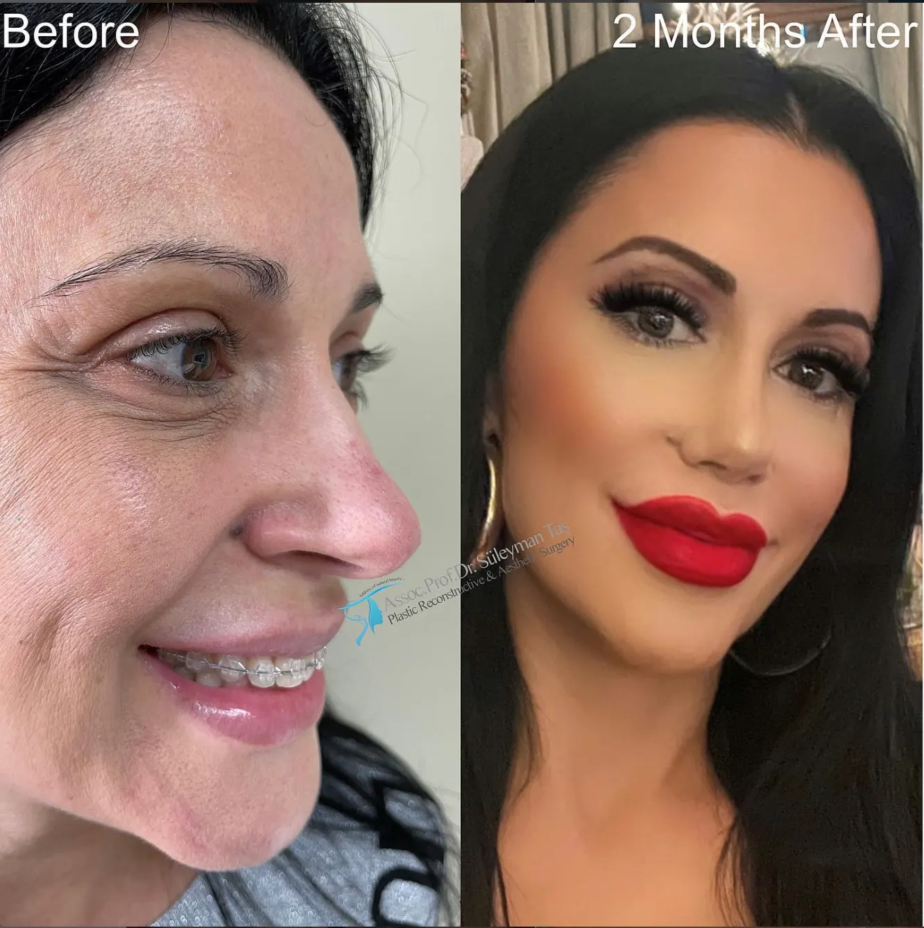 Suleyman Tas reviews – verified facelift patient review #89 (photo 4)