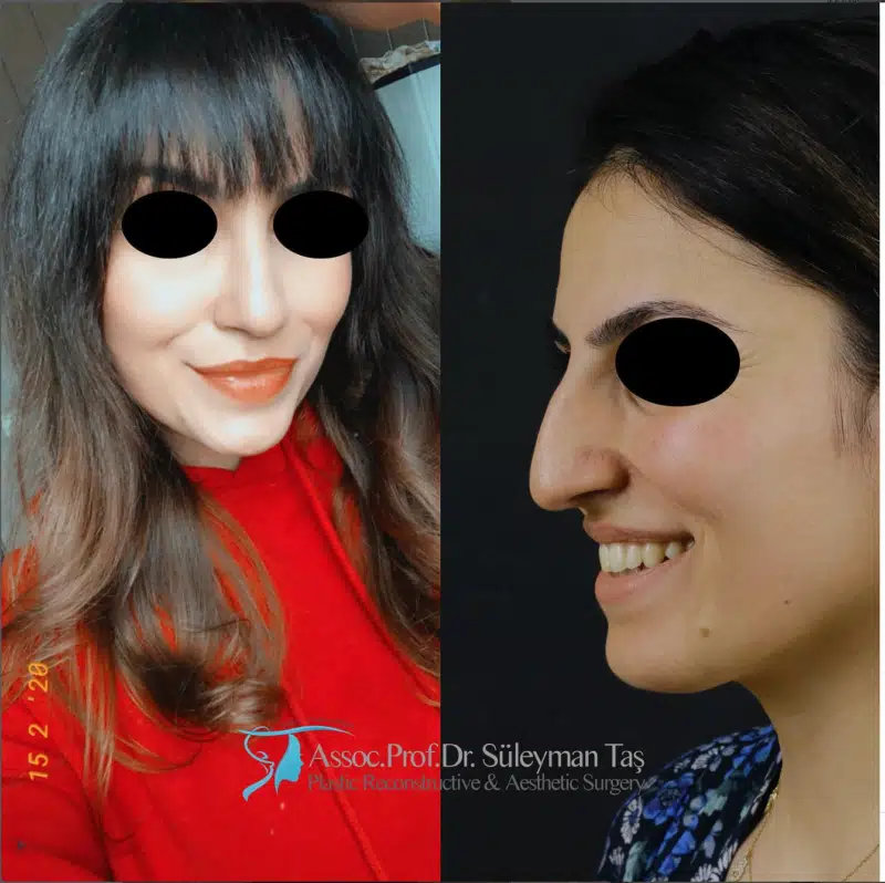 Suleyman Tas reviews – verified rhinoplasty patient review #187 (photo 1)