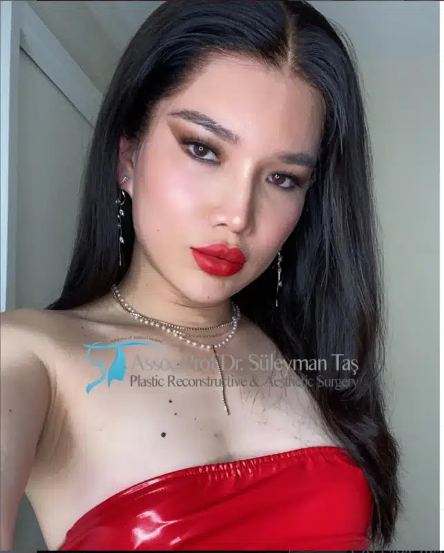 Suleyman Tas reviews – verified rhinoplasty patient review #185 (photo 3)