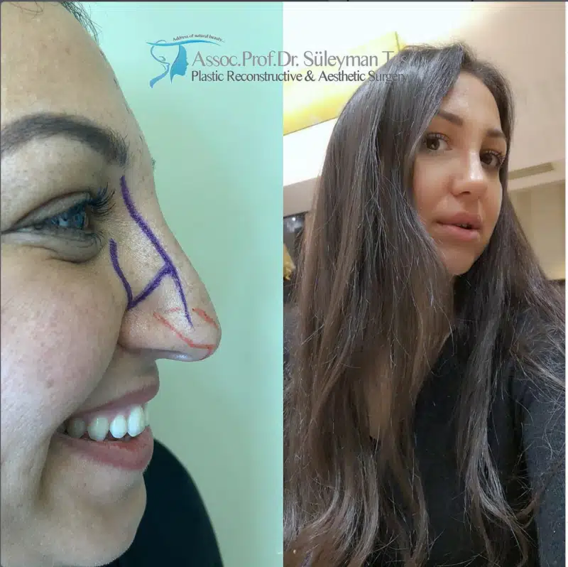 Suleyman Tas reviews – verified rhinoplasty patient review #183 (photo 2)