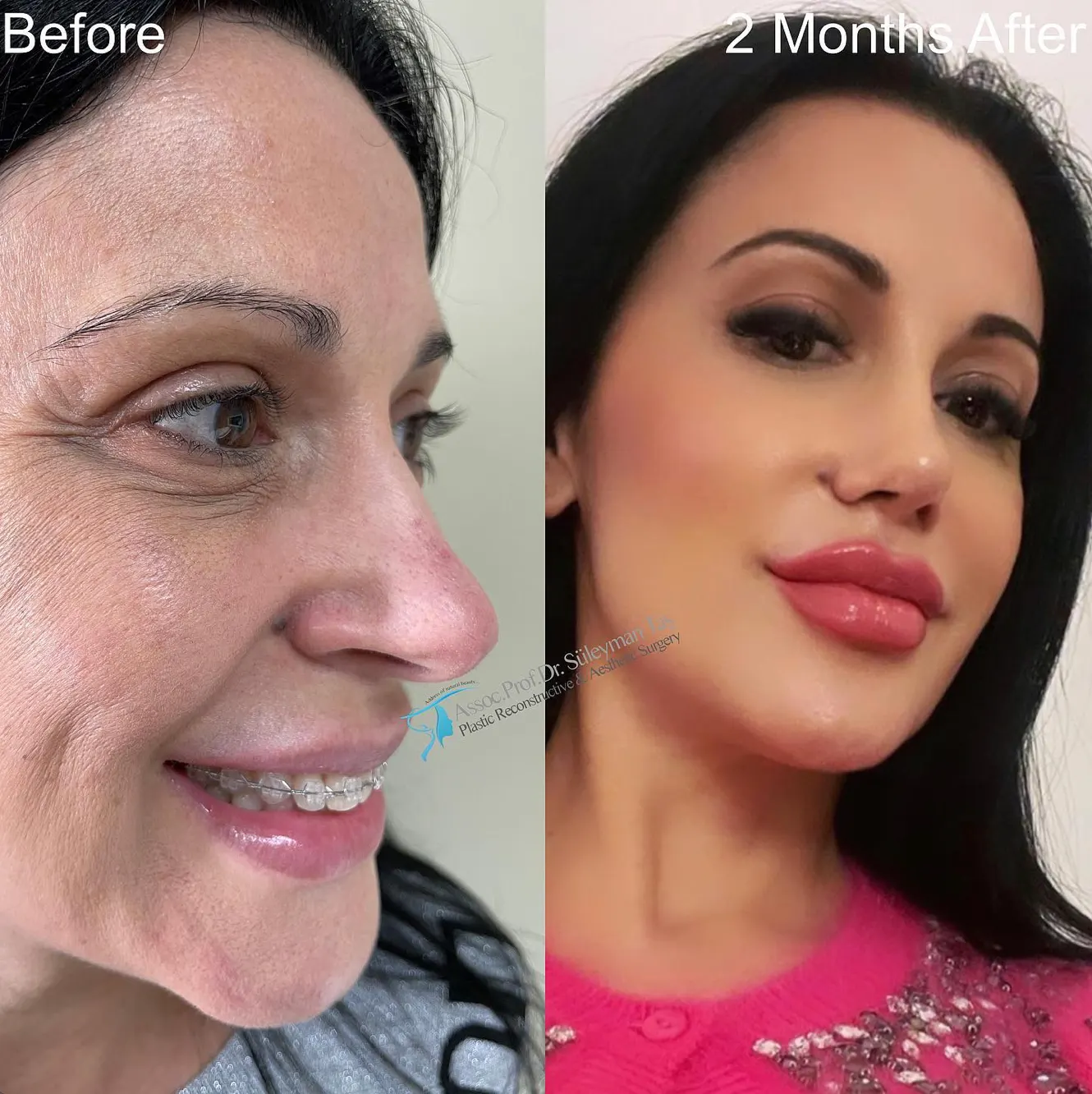 Suleyman Tas reviews – verified facelift patient review #89 (photo 3)