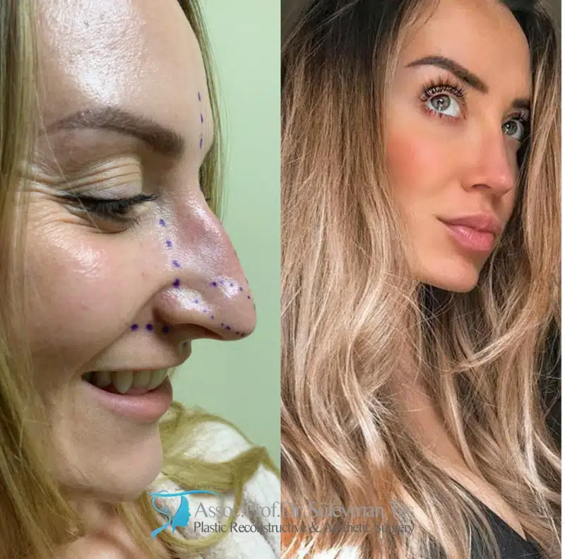 Suleyman Tas reviews – verified rhinoplasty patient review #174 (photo 1)